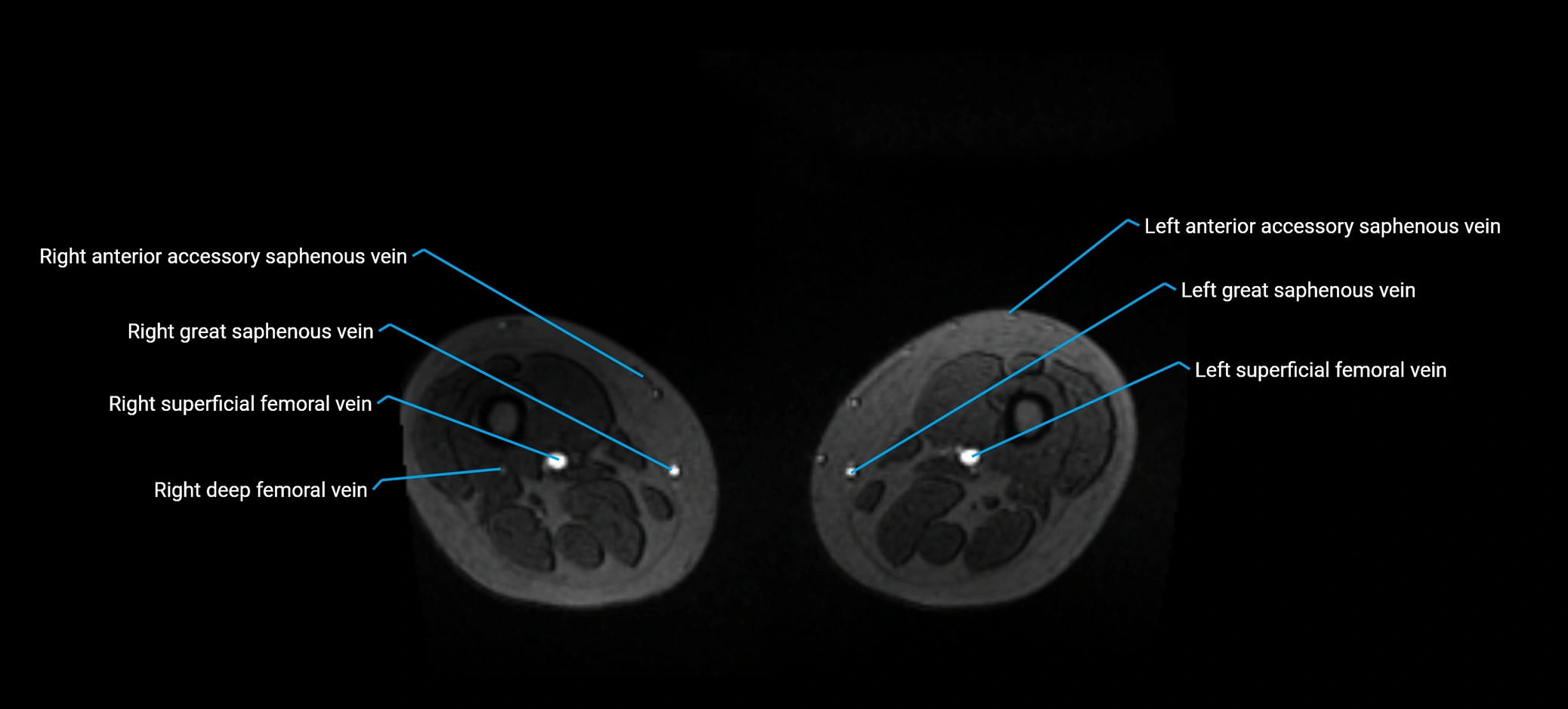 MRV abdomen pelvis & lower limb axial cross sectional anatomy labelled MRI image 305 (1).webp